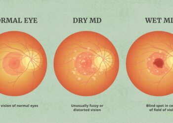 WHICH SUPPLEMENTS CAN PREVENT AGE-RELATED MACULAR DEGENERATION?