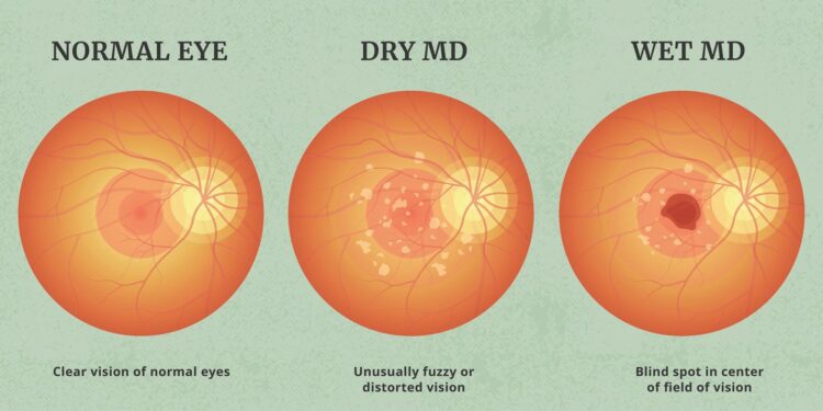 WHICH SUPPLEMENTS CAN PREVENT AGE-RELATED MACULAR DEGENERATION?